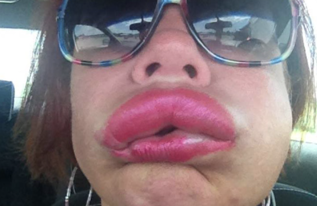 Vollere lippen? Probeer dit alternatief op lip fillers!