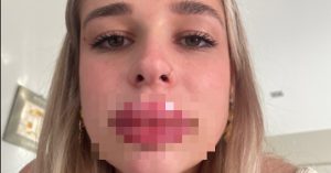Lipfiller Horror: Extreme allergische reactie zorgt voor diepe spijt