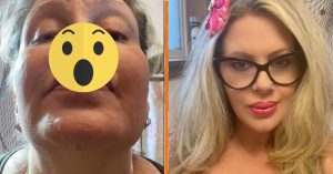 Horrorverhaal: Vrouw (52) ervaart nachtmerrieachtige gevolgen na filler-injectie