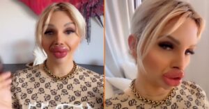 Influencer moet XL-lip Fillers kan nu niet goed eten en drinken