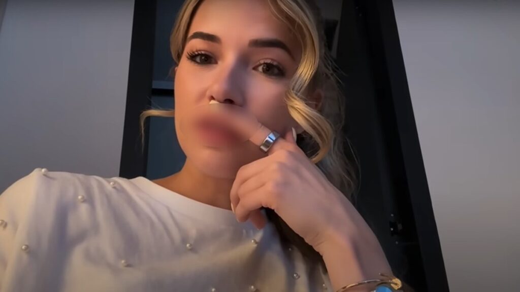 Jade Anna lippen nog erg opgezwollen na opspuiten