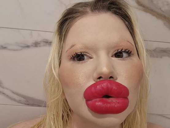 Bulgaarse influencer met 'grootste lippen ter wereld' 