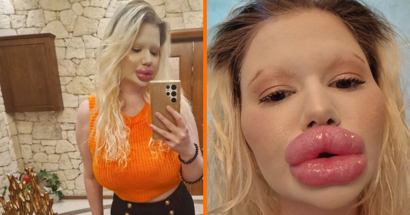 Bulgaarse influencer met 'grootste lippen ter wereld' kan geen liefde vinden