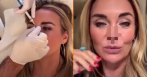 Monique Westenberg deelt resultaat 'mislukte' neus-operatie: 'Het is een soort boksneus geworden