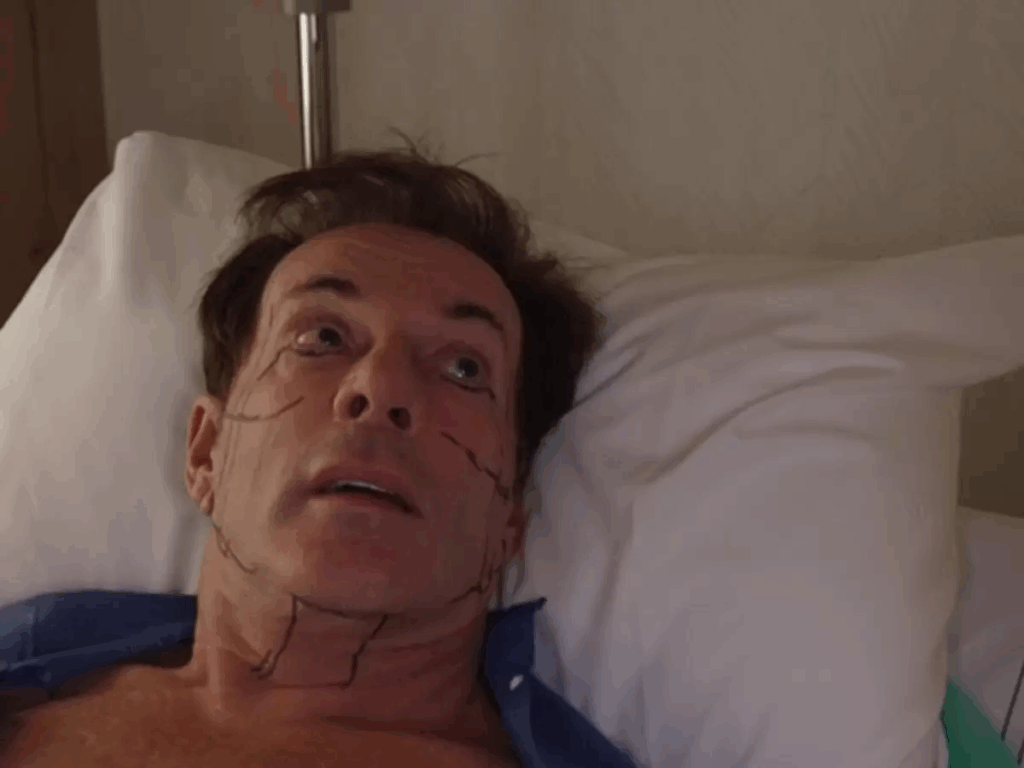 Gerard Joling facelift